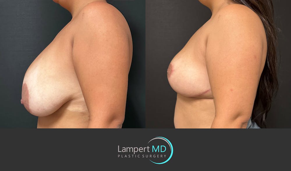 Breast Explant Before & After Gallery - Patient 276775 - Image 5