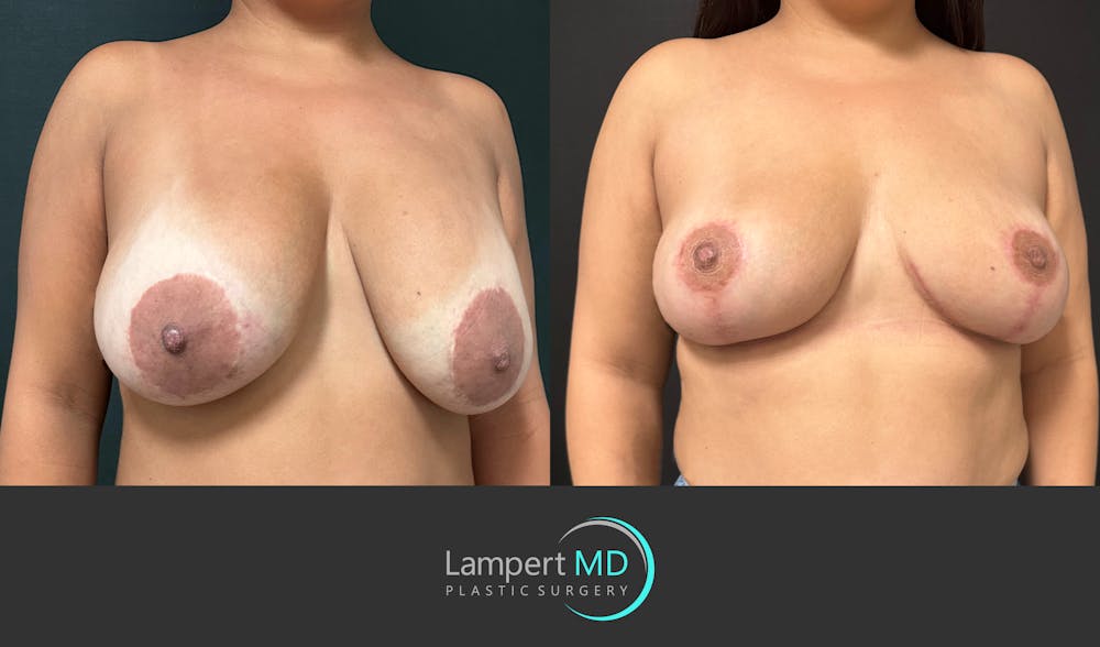 Breast Explant Before & After Gallery - Patient 276775 - Image 2