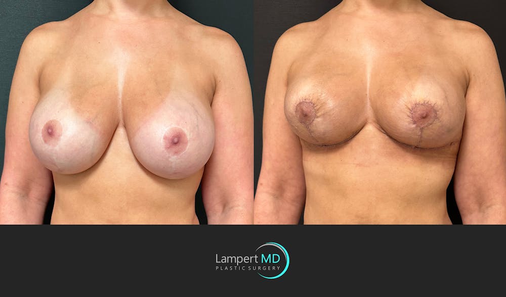 Breast Explant Before & After Gallery - Patient 411818 - Image 4