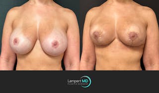 Breast Explant Before & After Gallery - Patient 411818 - Image 4