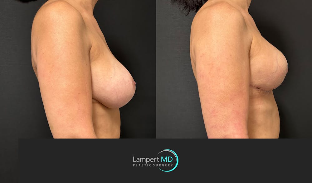 Breast Explant Before & After Gallery - Patient 411818 - Image 3