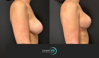 Breast Explant Before & After Gallery - Patient 411818 - Image 3