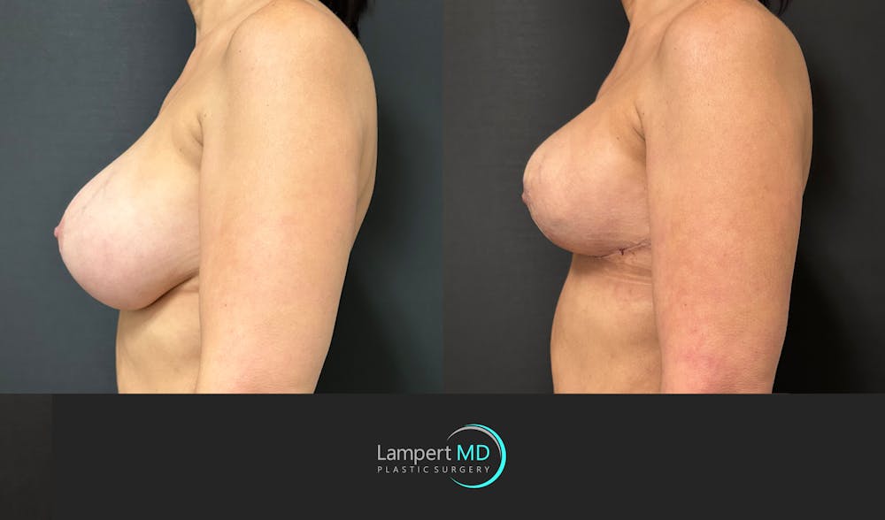 Breast Explant Before & After Gallery - Patient 411818 - Image 5