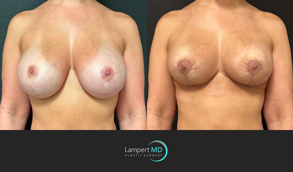 Breast Explant Before & After Gallery - Patient 411818 - Image 1