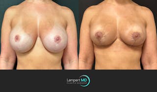 Breast Explant Before & After Gallery - Patient 411818 - Image 1