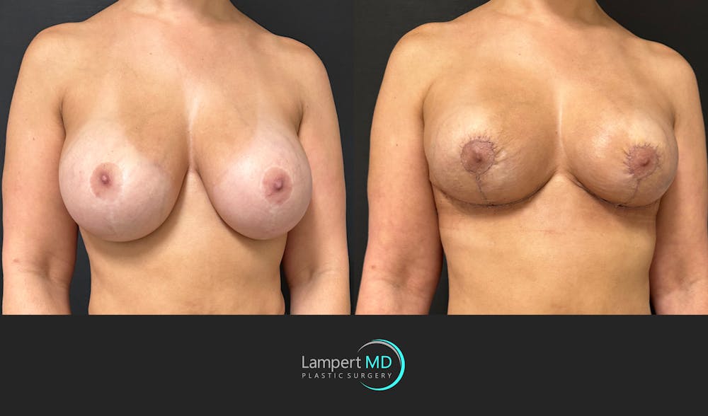 Breast Explant Before & After Gallery - Patient 411818 - Image 2
