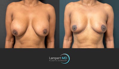 Breast Explant Before & After Gallery - Patient 226211 - Image 1