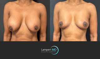 Breast Explant Before & After Gallery - Patient 226211 - Image 4