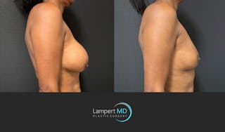 Breast Explant Before & After Gallery - Patient 226211 - Image 3