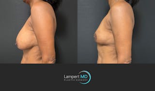 Breast Explant Before & After Gallery - Patient 226211 - Image 5