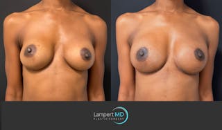 Breast Reconstruction Before & After Gallery - Patient 246849 - Image 1