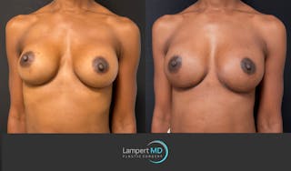 Breast Reconstruction Before & After Gallery - Patient 246849 - Image 3