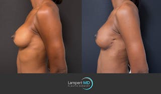 Breast Reconstruction Before & After Gallery - Patient 246849 - Image 5