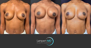 Breast Reconstruction Before & After Gallery - Patient 246849 - Image 2