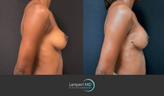 Breast Reconstruction Before & After Gallery - Patient 246849 - Image 4
