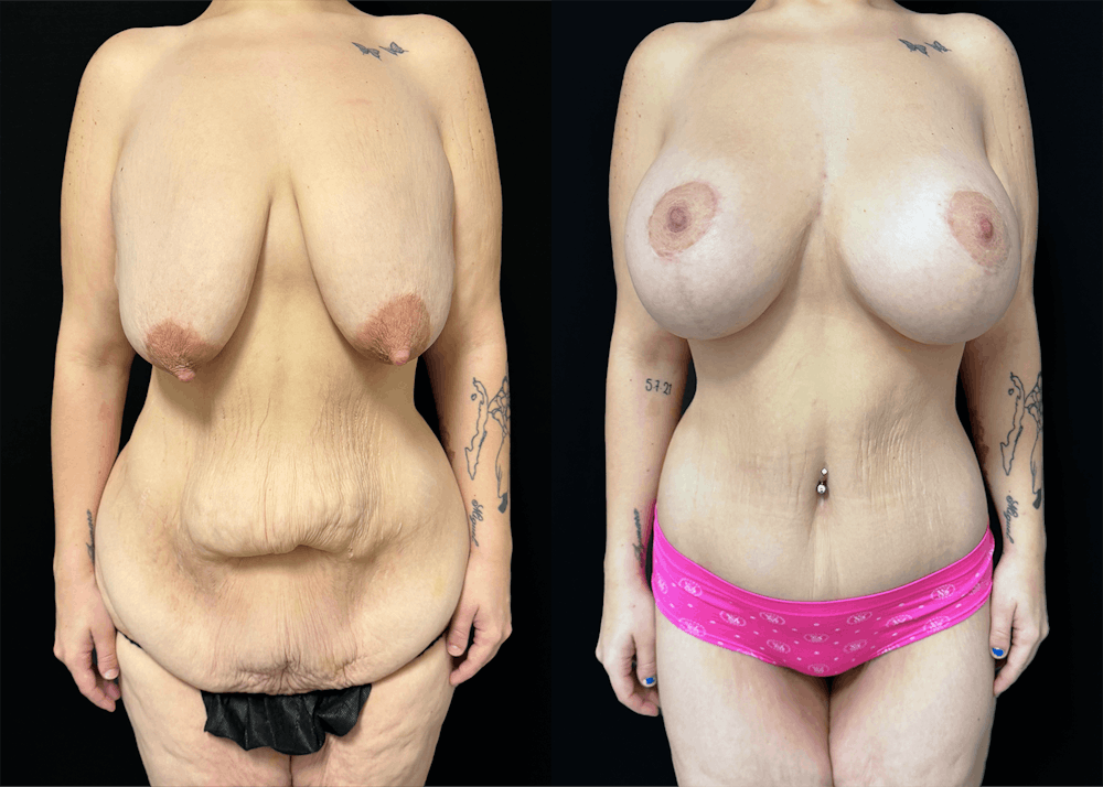 Lower Body Lift Before & After Gallery - Patient 122931146 - Image 2