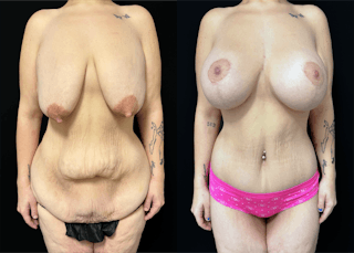 Lower Body Lift Before & After Gallery - Patient 122931146 - Image 2