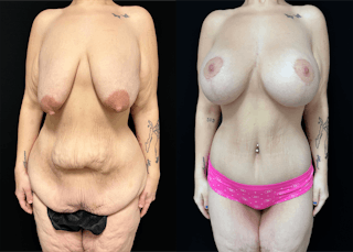 Lower Body Lift Before & After Gallery - Patient 122931146 - Image 5