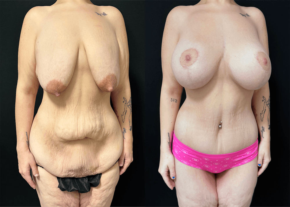 Lower Body Lift Before & After Gallery - Patient 122931146 - Image 3