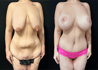 Lower Body Lift Before & After Gallery - Patient 122931146 - Image 3