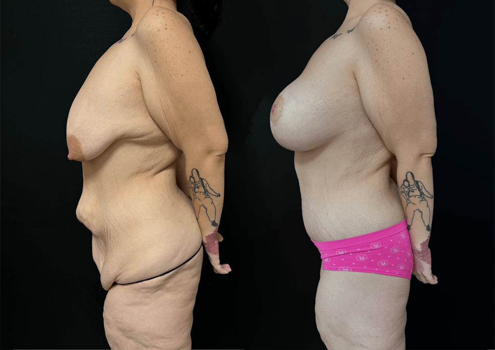 Lower Body Lift Before & After Gallery - Patient 122931146 - Image 6