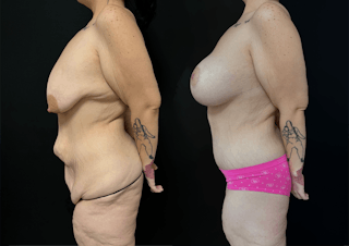 Lower Body Lift Before & After Gallery - Patient 122931146 - Image 6