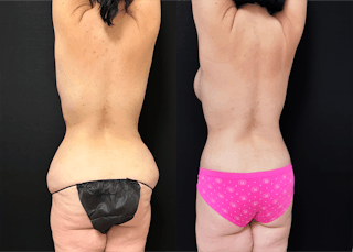 Lower Body Lift Before & After Gallery - Patient 122931146 - Image 8