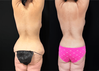 Lower Body Lift Before & After Gallery - Patient 122931146 - Image 9