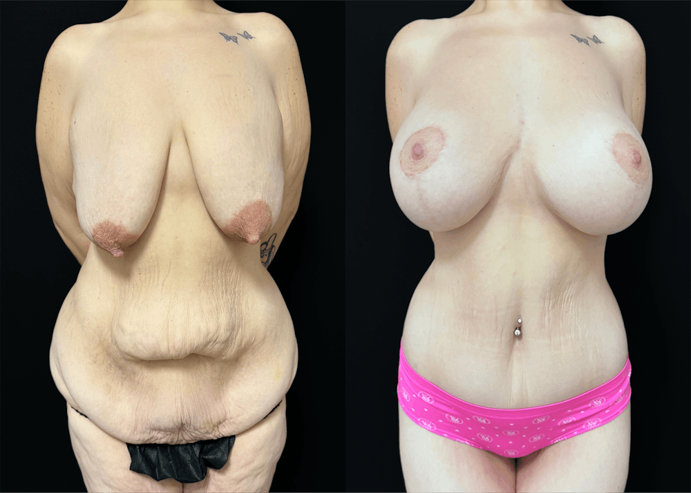 Lower Body Lift Before & After Gallery - Patient 122931146 - Image 1