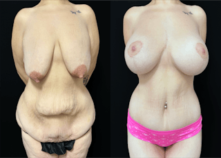 Lower Body Lift Before & After Gallery - Patient 122931146 - Image 1
