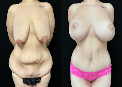 Lower Body Lift Before & After Gallery - Patient 122931146 - Image 1
