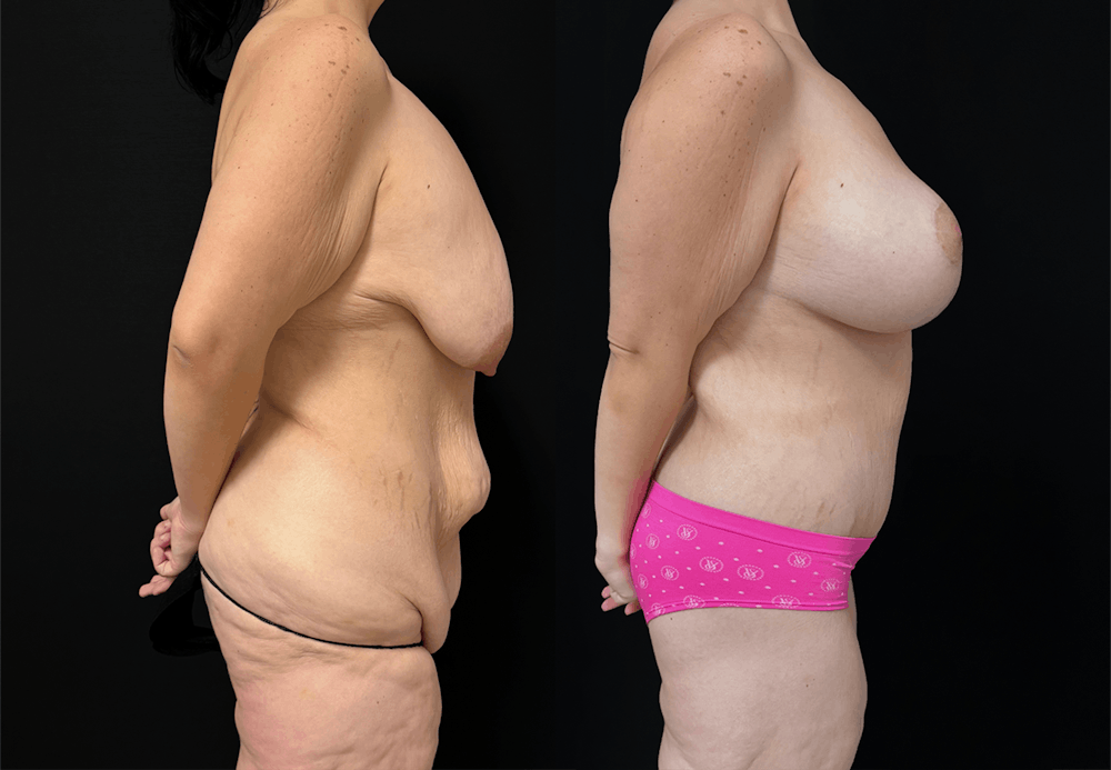 Lower Body Lift Before & After Gallery - Patient 122931146 - Image 4
