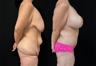 Lower Body Lift Before & After Gallery - Patient 122931146 - Image 4