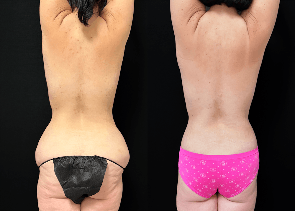 Lower Body Lift Before & After Gallery - Patient 122931146 - Image 7