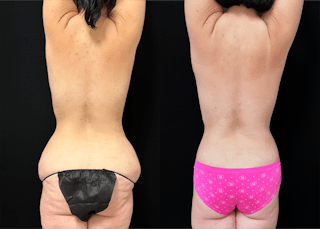 Lower Body Lift Before & After Gallery - Patient 122931146 - Image 7