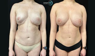 Breast Revision Before & After Gallery - Patient 813643 - Image 1