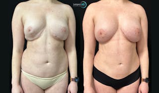 Breast Revision Before & After Gallery - Patient 813643 - Image 2