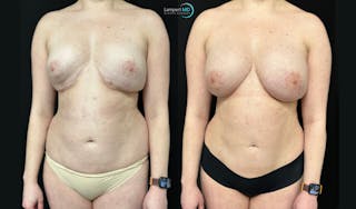 Breast Revision Before & After Gallery - Patient 813643 - Image 3