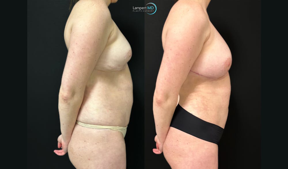 Breast Revision Before & After Gallery - Patient 813643 - Image 4