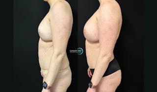 Breast Revision Before & After Gallery - Patient 813643 - Image 5