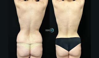 Breast Revision Before & After Gallery - Patient 813643 - Image 6