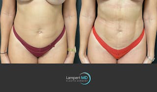 Liposuction Before & After Gallery - Patient 192669 - Image 1