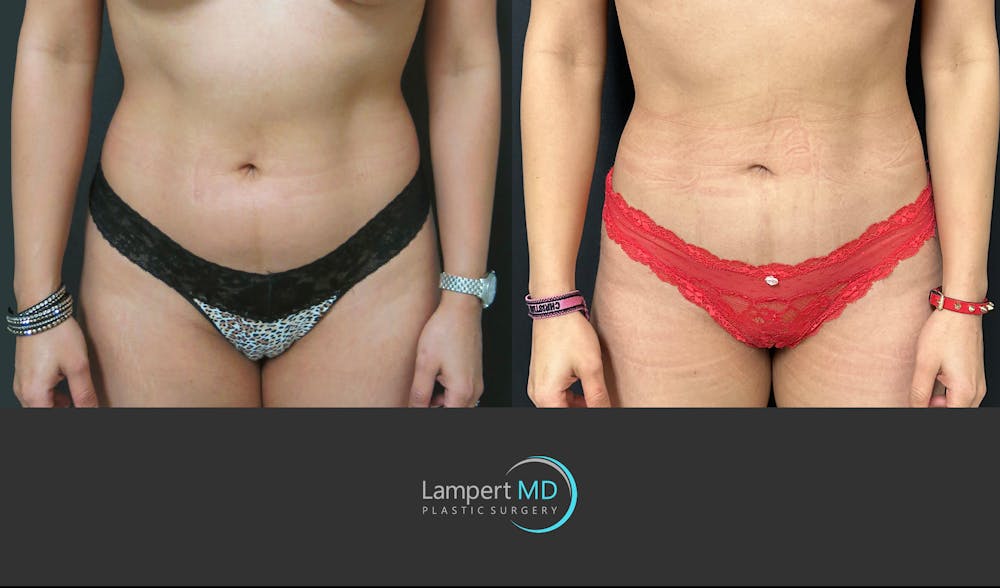 Liposuction Before & After Gallery - Patient 323557 - Image 1