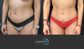 Liposuction Before & After Gallery - Patient 323557 - Image 2