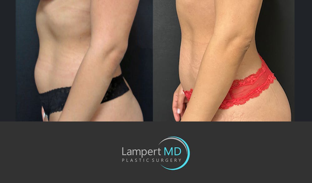 Liposuction Before & After Gallery - Patient 323557 - Image 3