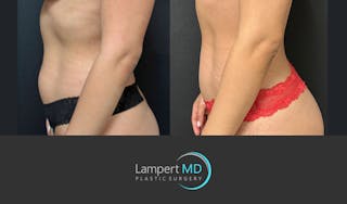 Liposuction Before & After Gallery - Patient 323557 - Image 3