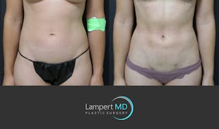 Liposuction Before & After Gallery - Patient 277173 - Image 1
