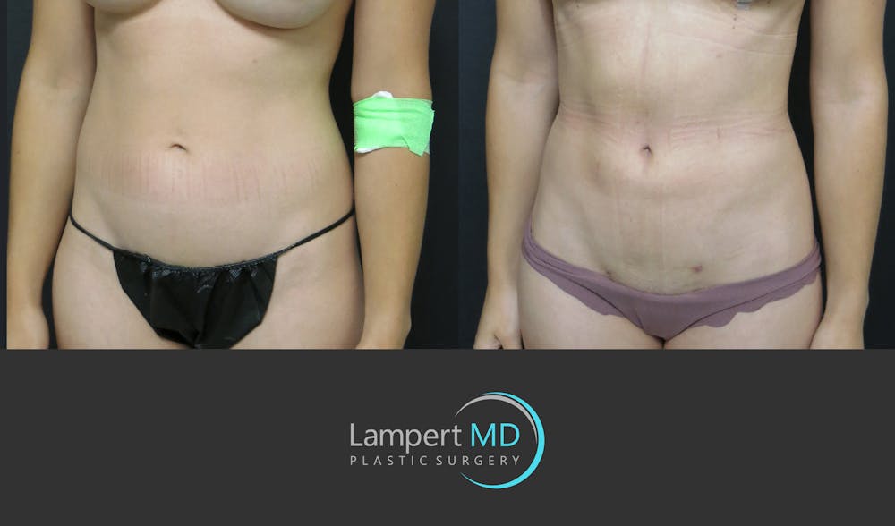 Liposuction Before & After Gallery - Patient 277173 - Image 2