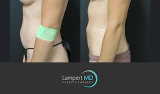 Liposuction Before & After Gallery - Patient 277173 - Image 3