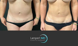 Liposuction Before & After Gallery - Patient 399300 - Image 1